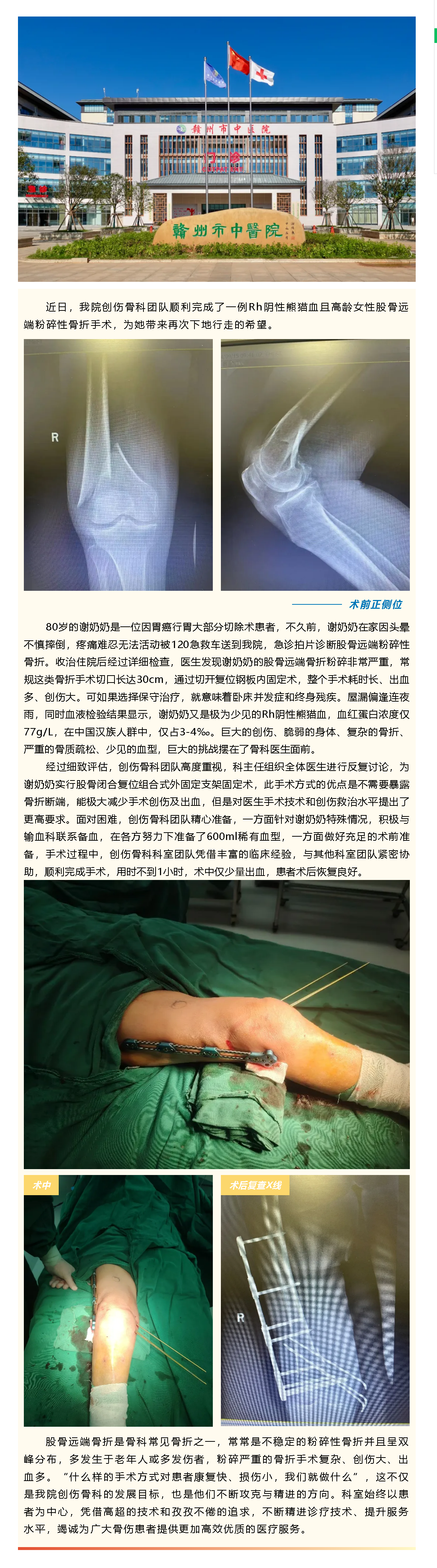 80歲粉碎性骨折阿婆竟是熊貓血，微創(chuàng)閉合復(fù)位破解創(chuàng)傷難題.png