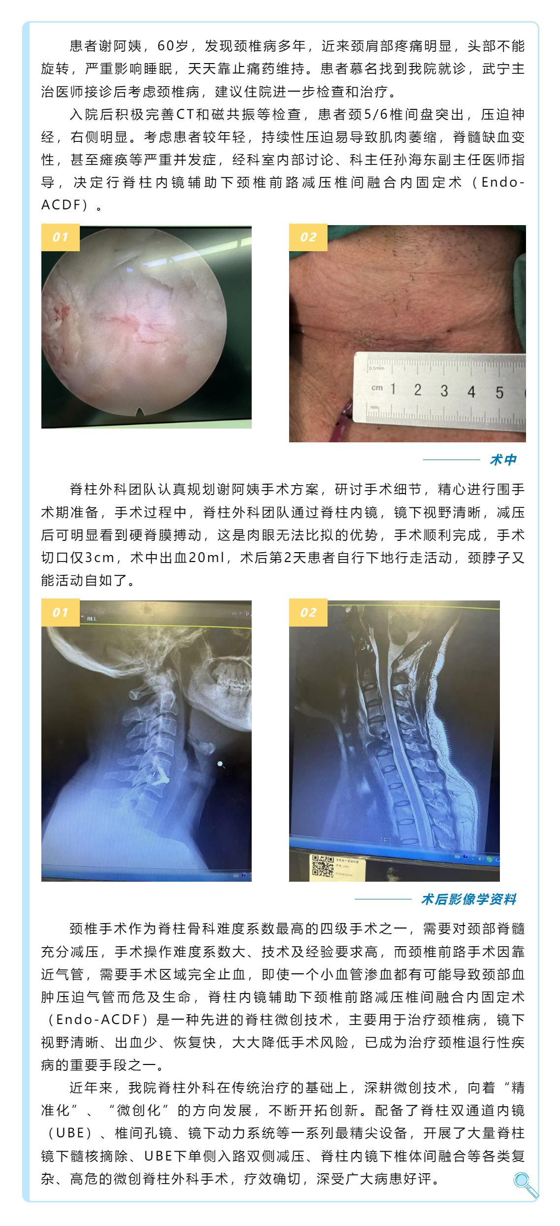 頸椎退行性疾病患者福音——頸椎前路減壓椎間融合內固定術.png